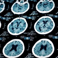 Компьютерная томография головного мозга и других органов